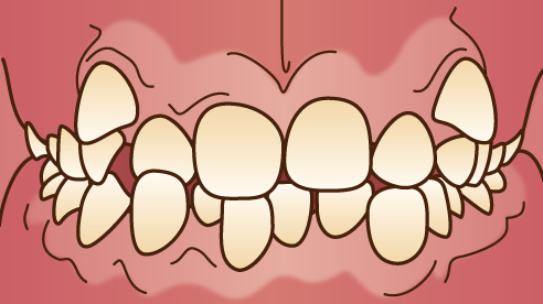 インビザライン 難症例