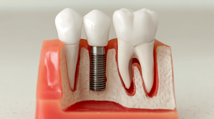 インプラントが虫歯にならないのはなぜ？