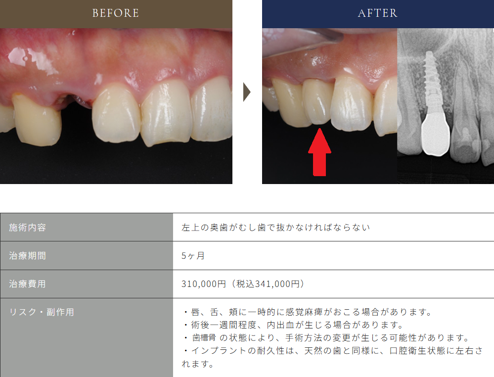 インプラント前歯症例