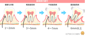 歯周病の進行度