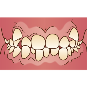 インビザライン　八重歯