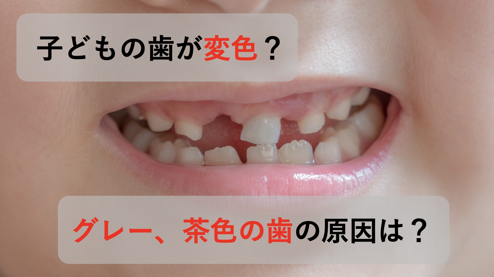 子どもの歯が茶色やグレーに変色した時の5つの原因と対処法 北戸田coco歯科 戸田市 北戸田市の歯医者