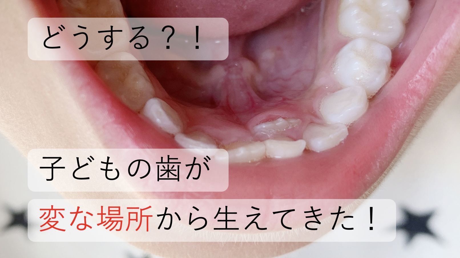 子どもの永久歯が変な場所から生えてきた 原因と対処法を詳しく解説 北戸田coco歯科 戸田市の歯医者