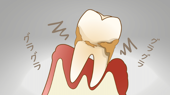 グラグラした歯の原因は重症化した歯周病の可能性が高い