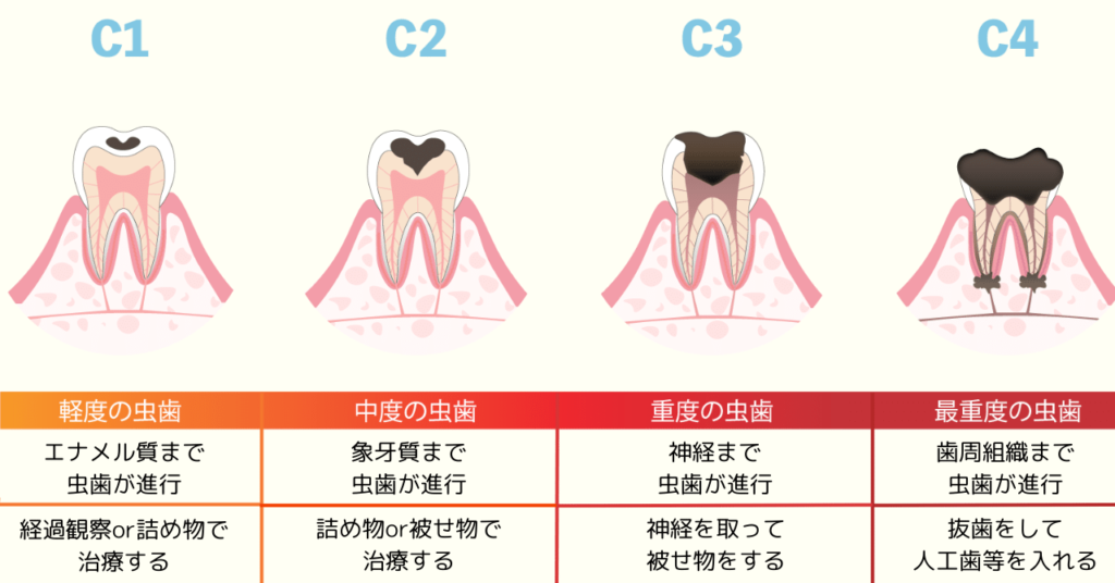 【進行度別】虫歯でボロボロな歯の治療法