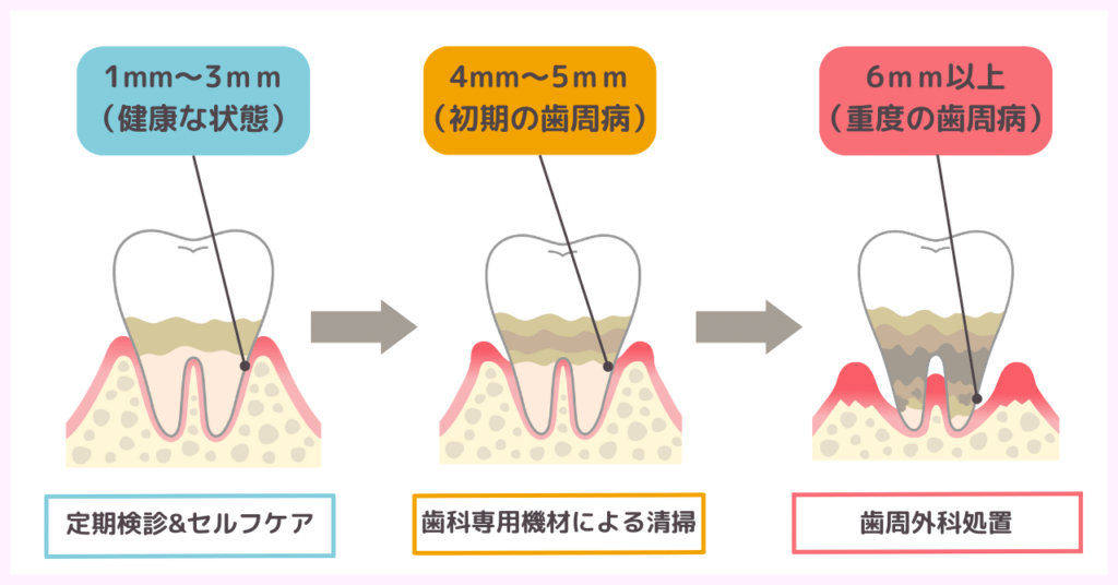 【段階別】歯周ポケットの深さ＆抜歯を回避する治療法
