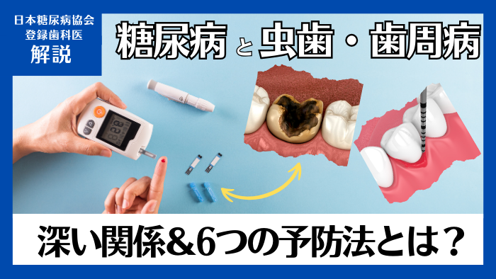 糖尿病と虫歯・歯周病は深い関係！歯科医師が教える予防法6選