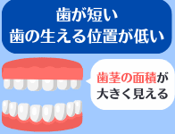 歯が短いまたは歯の生える位置が低い