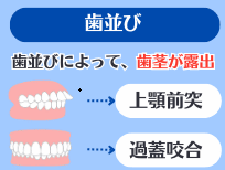 歯並び（過蓋咬合や上顎前突）