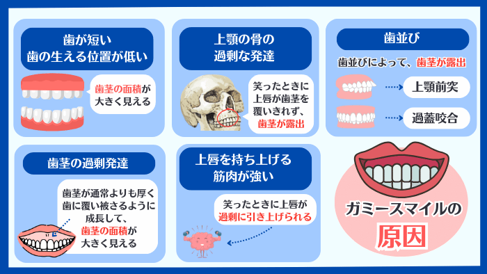 ガミースマイルの5つの原因